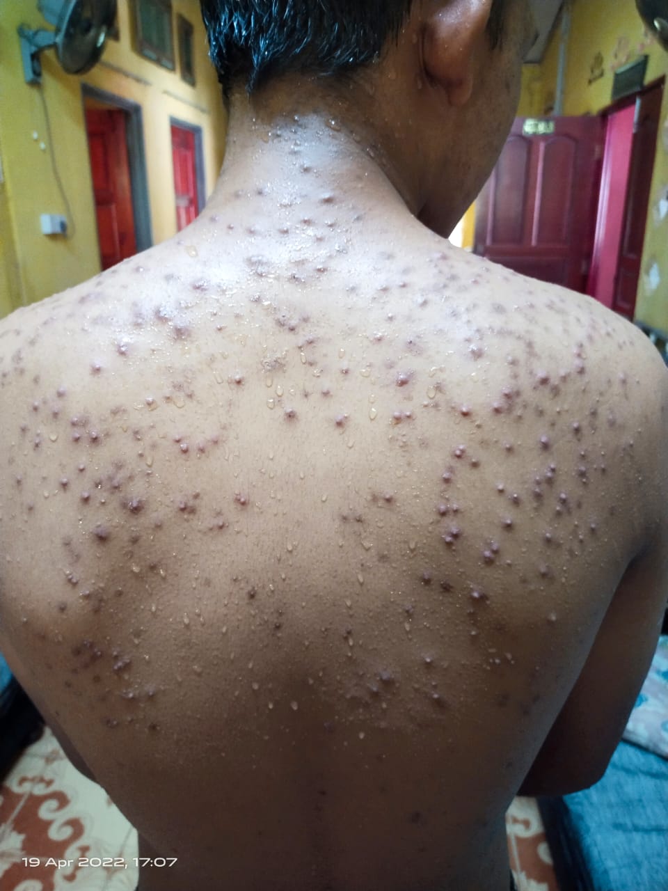 Body acne before treatment